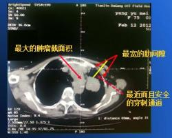 3D打印“引路”放射性粒子精準殺傷腫瘤